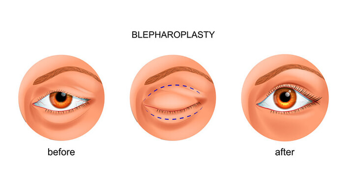 Chart Showing Before and After a Blepharoplasty Procedure